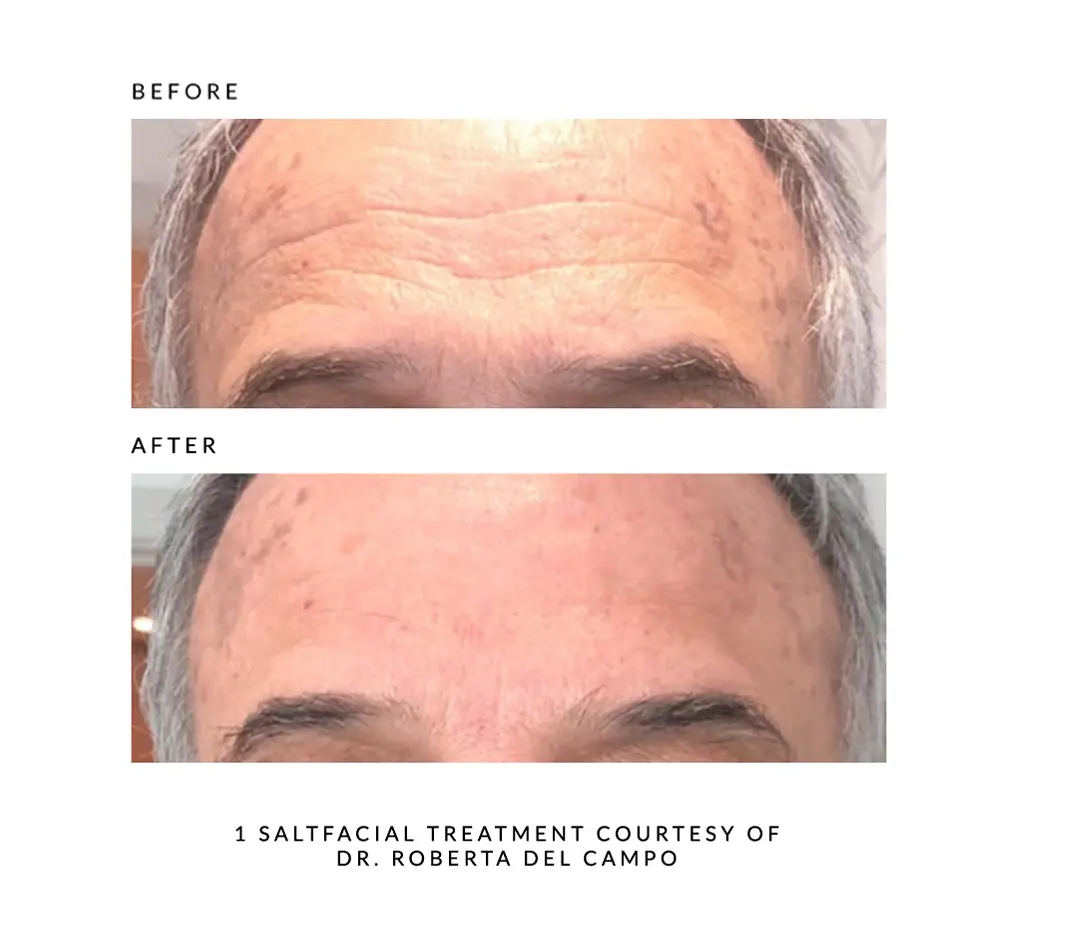 A man 's face before and after a facial treatment.